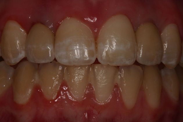 After Dental Implants